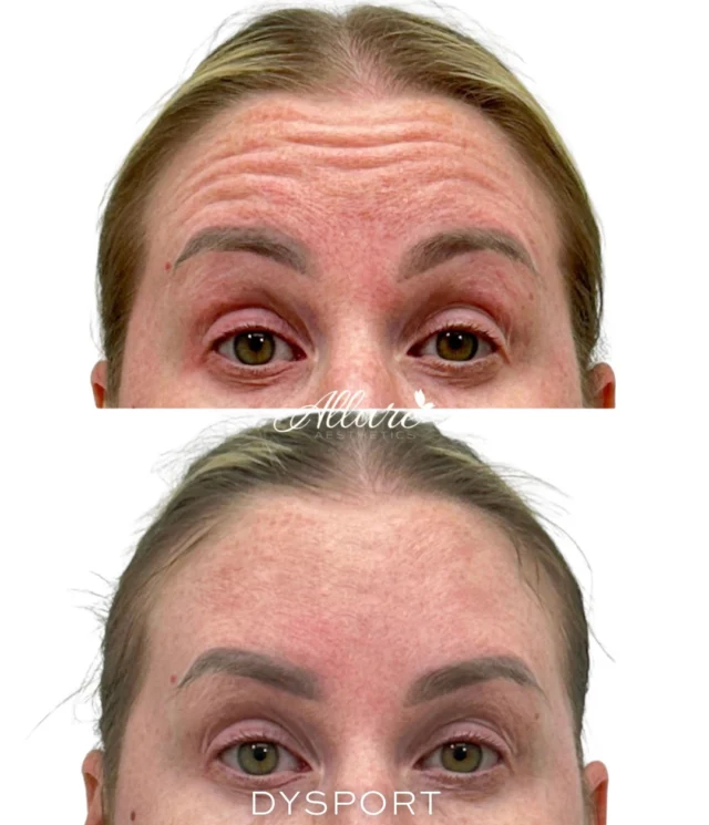 Your face is meant to move, smile, laugh, frown, raise your brows, but over time those repeated expressions can start to leave lines behind.

In these before and afters, you can see how Dysport helps soften the appearance of expression lines created from everyday movement, while still keeping natural facial expression. From frown lines to forehead creasing and raised brow lines, treatment is customized to help you look refreshed, not frozen.

Full results typically seen around 2 weeks after treatment. 

✨Results may vary per individual.

Ready for smoother, softer expression lines? Schedule your consultation with our expert injectors today.

#Dysport #AllureAesthetics #AntiWrinkleTreatment #ForeheadLines #FrownLines NaturalResults"