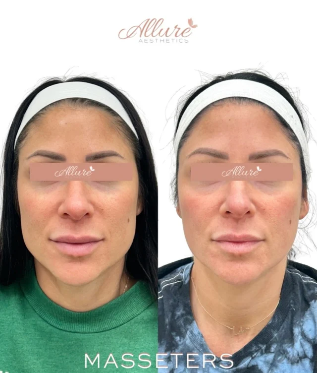 A slimmer, softer facial shape without surgery. ✨

The masseter muscles, located at the angle of the jaw, can become enlarged over time from clenching, grinding, stress, or naturally stronger muscle anatomy. By strategically treating the masseters with neurotoxin, we were able to help relax the muscle and create a more narrowed, contoured lower face appearance over time.

In these before and afters, you can see how facial slimming can completely soften and refine the overall shape of the face while still maintaining natural balance and movement.

Results develop gradually over several weeks as the muscle begins to relax and reduce in size. Results may vary per individual.

Interested in lower face slimming or jawline contouring? Schedule your consultation with our expert injectors at Allure Aesthetics.

#MasseterBotox #FacialSlimming #JawlineContour #AllureAesthetics #NaturalResults Dysport"
