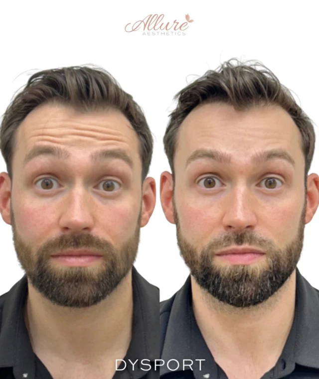 Confidence isn’t just for women.

This Father’s Day, give Dad something that lasts longer than a tie or a new grill, give him the confidence to look as refreshed and energized as he feels.

Dysport is a quick, non-surgical treatment that helps soften forehead lines, frown lines, and signs of aging while maintaining a natural, masculine appearance. No downtime. No drastic changes. Just a more rested, confident version of you.

Because self-care isn’t just for moms. Men deserve to feel confident in their skin, too.

* Results may vary
