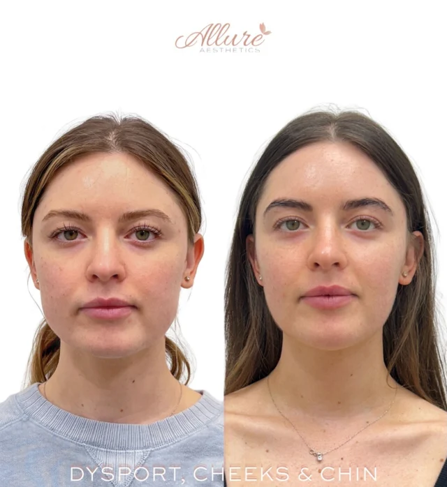 Lower Face Refinement Starts with Balance ✨

This patient’s treatment plan focused on more than a single feature. By combining Dysport in the masseter muscles with cheek and chin filler, we addressed facial proportion, lower face width, and structural support to create a more balanced appearance.

Masseter Dysport helps reduce excessive muscle activity in the lower face, which can soften a wider jawline over time. Strategic cheek support can improve midface structure, while chin enhancement helps create harmony between the upper, mid, and lower face.

The goal isn’t to change how someone looks. It’s to refine facial balance and support the features they already have.

Treatment performed:
• Dysport to the masseters
• Cheek filler
• Chin filler

Results shown are after treatment progression and may vary per individual. Results may vary per individual.

Ready to explore a customized treatment plan? Book your desired treatment and our providers will assess your anatomy in person to determine the most appropriate approach.

#AllureAesthetics #FacialBalancing #MasseterDysport #ChinFiller #CheekFiller FullFaceRefresher®