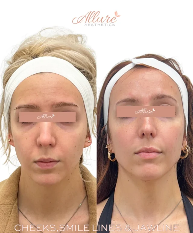 Facial Balance Isn’t About Adding Volume. It’s About Creating Structure.✨

This patient’s treatment plan focused on strategic cheek, smile line, and jawline enhancement to improve facial proportion and support areas that can change over time.

The cheeks were treated to restore structural support through the midface, helping create a smoother transition into the lower face. Addressing the smile lines was not simply about softening a crease, but improving the surrounding support that contributes to their appearance. Jawline enhancement helped create greater definition and continuity from the cheeks to the chin, resulting in a more balanced profile from every angle.

When multiple areas work together, the outcome is often more harmonious than treating a single feature alone.

Treatment performed:
• Cheek filler
• Smile line filler
• Jawline filler

Interested in learning whether facial balancing may be appropriate for your anatomy? Schedule a personalized consultation with one of our providers.

Results may vary per individual.💗

#AllureAesthetics #FacialBalancing #JawlineFiller #CheekFiller #SmileLineFiller