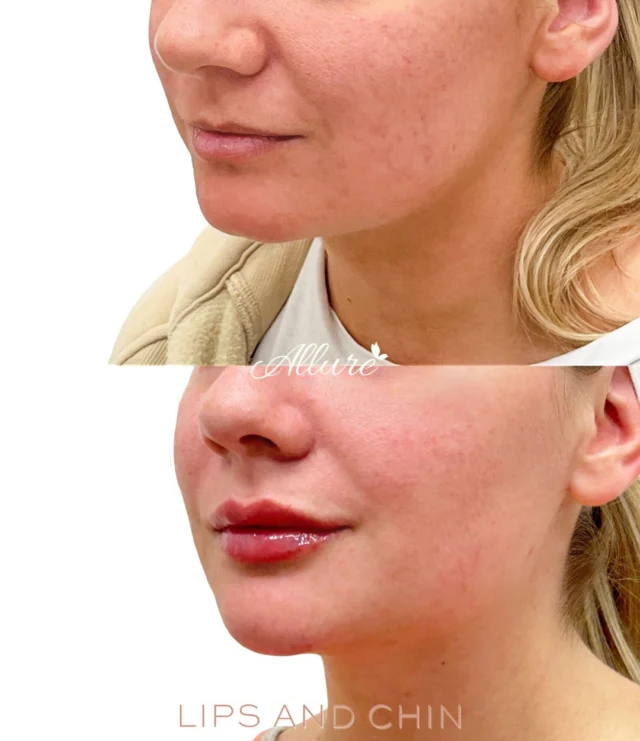 Sometimes the smallest enhancements create the biggest difference in overall facial balance.

By combining lip filler with chin filler, we were able to enhance facial harmony, improve profile balance, and create a more proportionate appearance without looking overdone. The lips were carefully enhanced for soft, natural volume and shape, while the chin was subtly projected to help strengthen and balance the lower face.

When the lips and chin are treated together strategically, the entire profile can appear more refined, structured, and balanced.

At Allure Aesthetics, every treatment plan is customized to your unique facial anatomy and aesthetic goals for results that still feel like you, just elevated.

Results may vary per individual.

Ready to enhance your profile naturally? Schedule your consultation with our expert injectors today.

#LipFiller #ChinFiller #FacialBalance #ProfileBalancing #AllureAesthetics NaturalResults"