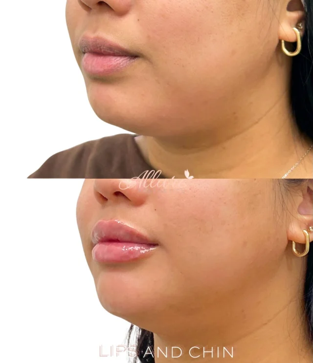 Sometimes the most impactful results come from treating more than one area.

In just one session, we enhanced the lips and chin to create improved facial balance and harmony.

For the lips, the goal was not simply volume. We focused on enhancing definition, refining the Cupid’s bow, improving hydration, and creating soft, beautifully balanced fullness.

The chin was strategically treated to provide additional projection and support to the lower face. Even a subtle enhancement can improve facial proportion and create a more harmonious profile.

When the lips and chin are treated together, the result is often not just a change in one feature. It is an improvement in the overall balance of the face.

✨ Enhanced lip definition
✨ Improved hydration and volume
✨ Refined facial proportion
✨ Better lower-face balance

All treatments are customized to the individual. Results vary.