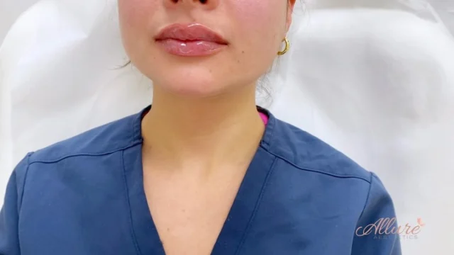 Freshly treated lips are only part of the story 💋 

What you see immediately after treatment is just the beginning ✨

Our goal is never just volume. It’s creating balanced shape, refined definition, and lips that complement your natural facial proportions💓

The final result is revealed as the lips settle, showcasing a beautifully customized enhancement designed specifically for you 👄 

Results vary by individual.

Ready to create a treatment plan that’s customized to you? Schedule your consultation through the link in our bio.