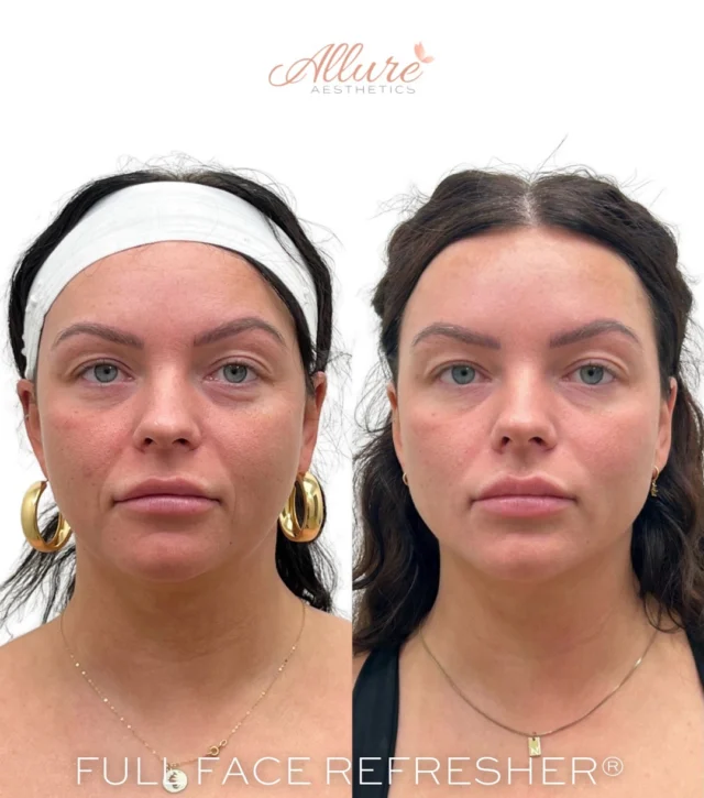 Not every Full Face Refresher® begins with adding filler. Sometimes the best approach is starting over with intention.

For this patient, we first dissolved previous lip filler before rebuilding with a more customized treatment plan. Dysport® was used to soften dynamic lines throughout the upper and lower face, while strategically placed under-eye, cheek, smile line, chin, jawline, and lip filler helped improve facial proportion, structural balance, and overall harmony.

Every Signature Full Face Refresher® is tailored to the individual. The goal is never to treat one area in isolation. It is to create balance across the entire face while respecting each patient’s unique anatomy.

Ready for a personalized treatment plan? Schedule your consultation with one of our providers to learn if the Signature Full Face Refresher® is right for you.

Results may vary per individual.