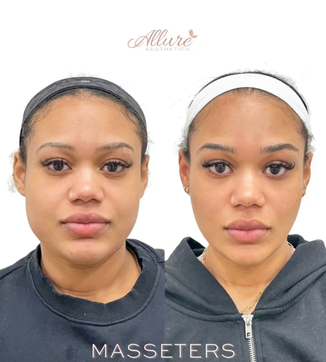A more refined jawline is not always achieved by adding volume.

In many cases, the masseter muscles play a significant role in the shape and structure of the lower face.

Located at the angle of the jaw, these muscles can become enlarged from clenching, grinding, or natural anatomy. When appropriate, neuromodulator treatment can help soften excessive muscle activity and improve overall facial proportion.

Benefits may include:

✨ A softer lower face appearance

✨ Improved facial balance

✨ Relief from jaw tension and teeth grinding for many patients

At Allure, our approach is centered on facial harmony. Every treatment plan is customized to support your natural features while maintaining balance and proportion.

Results vary by individual. Consultation required to determine candidacy.