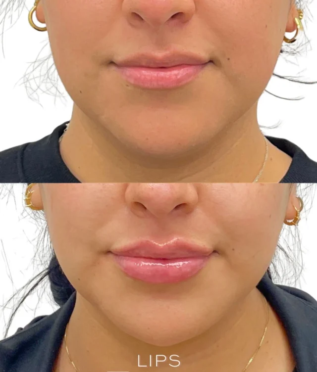 LIPS 👄

A refined approach to lip enhancement is never just about adding volume. It’s about improving structural balance, enhancing hydration, and creating facial proportion that complements your natural features.

In this before & after, our provider enhanced the cupid’s bow for greater definition, restored hydration for a healthier lip appearance, and added balanced volume to improve shape without compromising harmony. The result is lips that appear smoother, more hydrated, and beautifully proportioned while maintaining natural movement and expression.

Every treatment is thoughtfully customized to your facial anatomy because beautiful results are achieved through balance, not overcorrection.

✨ Personalized treatment plans begin with a comprehensive consultation to determine the approach that’s right for you.

Results may vary. #AllureAesthetics #LipFiller #LipEnhancement #FacialBalance #StructuralBalance CupidsBow HydratedLips MedicalAesthetics"