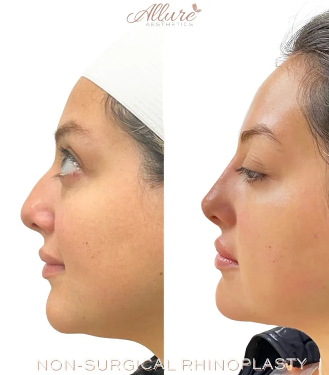 A non-surgical rhinoplasty is designed to enhance the overall profile by strategically placing filler to create the appearance of a smoother, more refined nose.👃 

In this transformation, we camouflaged the dorsal hump, creating a straighter profile while adding subtle support to the nasal tip for a more lifted, balanced appearance. The result is improved facial harmony without surgery, incisions, or downtime.✨

Every treatment is thoughtfully customized to complement your unique facial proportions because even small adjustments can make a significant impact. 💞

Ready to learn if a non-surgical rhinoplasty is right for you? Schedule a consultation with our expert injectors today.

Results vary by individual.