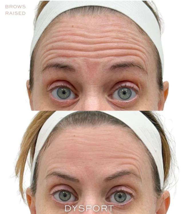 Your facial expressions tell a story.✨

Every time you raise your brows, the frontalis muscle contracts. When you scrunch your nose, the muscles responsible for bunny lines activate. When you smile, the orbicularis oculi create the dynamic lines commonly seen around the eyes.💞

Over time, repeated muscle movement can cause these expression lines to become visible even when the face is at rest.

Dysport works by temporarily relaxing targeted muscles responsible for these repetitive movements while preserving natural facial expression and movement.

• Forehead lines → caused by raising the brows
• Bunny lines → caused by scrunching the nose
• Crow’s feet → caused by smiling and squinting

The goal is not to eliminate expression.

The goal is to soften the repetitive muscle activity that contributes to etched lines over time while maintaining facial balance and natural movement.

At Allure, treatment plans are customized based on your anatomy, muscle strength, and facial dynamics to create a refined and individualized result.✨

Results may vary.

#AllureAesthetics #Dysport #PreventativeAging #DynamicLines #FacialAssessment Injectables AestheticMedicine FacialBalance NaturalResults"