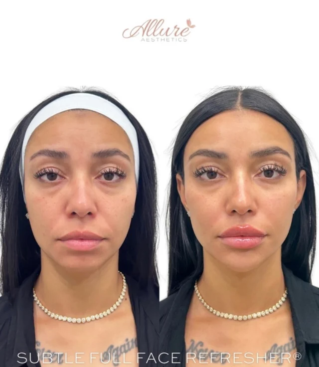 This wasn’t about adding volume. It was about creating structural balance throughout the face. ✨

Using our Signature Full Face Refresher®, treatment began with the cheeks to improve midface support and create a subtle lifting effect through the lower face and jawline.🙌

The lips 👄 were then treated to enhance hydration, definition, and overall facial harmony while maintaining proportions that complemented her natural anatomy.💞

Finally, the chin and jawline were refined to improve lower facial support, projection, and balance.

The result is a more supported, harmonious appearance while preserving what makes her look like herself.

Refined. Balanced. Individualized. Results may vary.

#FullFaceRefresher #AllureAesthetics #FacialBalancing #CheekFiller #LipFiller ChinFiller JawlineContour StructuralSupport AestheticMedicine