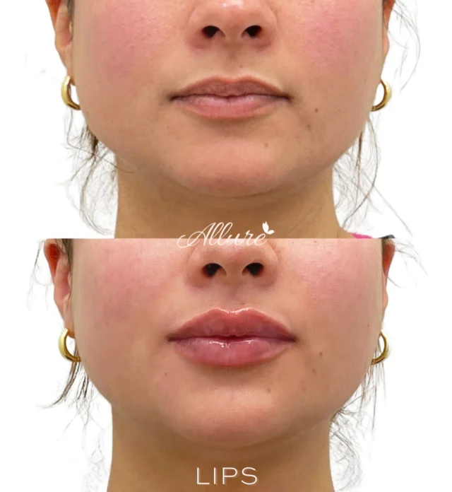 This treatment was designed to enhance hydration, refine the lip border, and create balanced proportions while preserving the patient’s natural shape. 💋 

Our approach is never about creating the same lips for every patient. It’s about designing results that complement your unique facial anatomy and aesthetic goals.✨

Schedule your personalized consultation to learn more.

Results may vary.