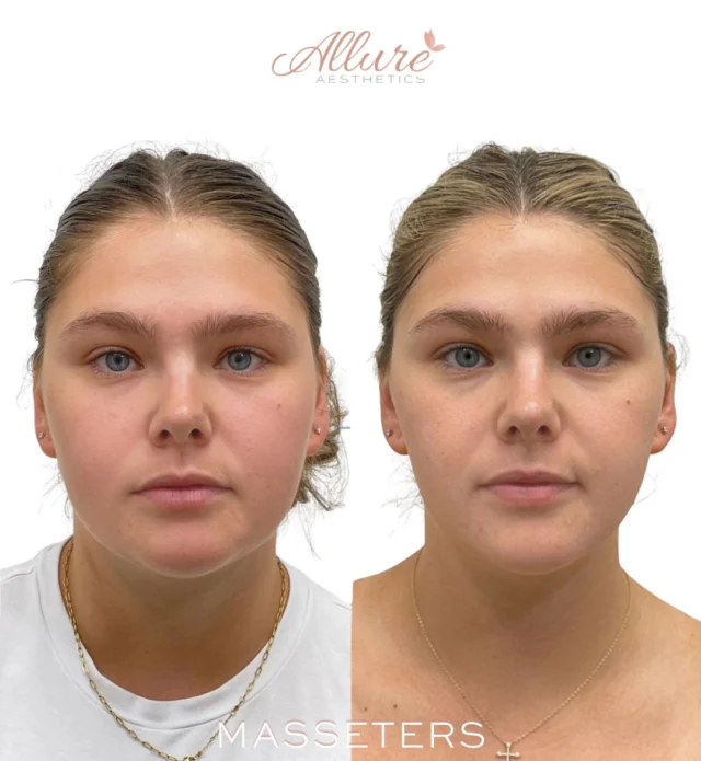 Reducing lower facial width can improve overall facial proportion without altering your natural features.

In this case, Dysport® was used to relax the masseter muscles, reducing excessive muscle activity that contributed to a wider lower face. As the muscle gradually decreases in size, the jawline appears more refined while maintaining facial balance and function.

If you’re interested in learning whether masseter Dysport® is right for you, schedule a consultation with one of our providers through the link in our bio.

Results may vary.