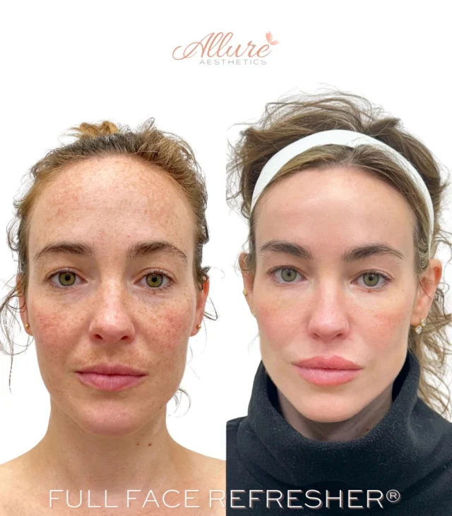 A customized Full Face Refresher® designed to restore balance, soften signs of aging, and enhance natural features. ✨

This personalized treatment plan included:
• Full face Dysport®
• Cheek filler
• Lip filler
• Chin filler
• Smile line filler
• Under-eye rejuvenation

To complement her injectable results, she also received a Perfect Derma™ Peel earlier this year to improve overall skin tone and texture.

Every Full Face Refresher® is thoughtfully customized to each patient’s unique facial anatomy and aesthetic goals. Schedule a consultation to learn which treatments are right for you. Results may vary.