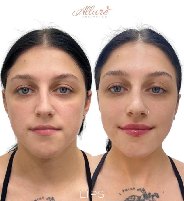 Subtle changes can make a meaningful difference.

This result was achieved in just one treatment session, with lip filler strategically placed to improve structural support, refine symmetry, and create balanced proportions while maintaining natural movement.

Every treatment plan is customized because no two lips or facial structures are the same.

Interested in learning what’s possible for you? Schedule your personalized consultation to discuss your goals with one of our providers.

✨ Results may vary.