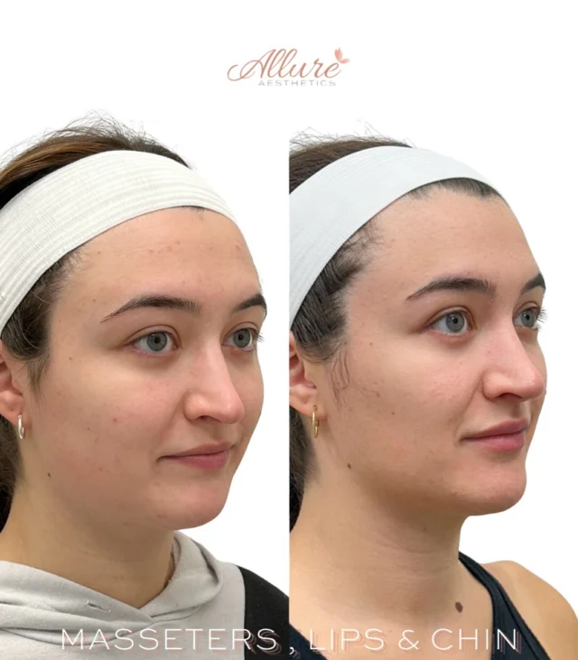 Sometimes, the most impactful results are the ones you can’t immediately identify.

This patient’s treatment was designed with subtle refinements that work together to support overall facial balance, not to change her appearance.

Treatment included:
✨ Masseter Dysport to soften the lower face and reduce muscle bulk, creating a more refined facial shape.
✨ Lip filler to improve structural support and maintain balanced proportions relative to the rest of the face.
✨ Chin filler to enhance projection and strengthen the side profile while supporting facial harmony.
✨ A Dysport nose tip lift to provide a subtle elevation of the nasal tip and complement the overall result.

When each treatment is performed with intention, the outcome isn’t about one feature, it’s about creating balance across the entire face through subtle, thoughtful enhancements.

Ready to learn what a personalized treatment could look like for you? Schedule a personalized consultation with one of our providers.

Results may vary.