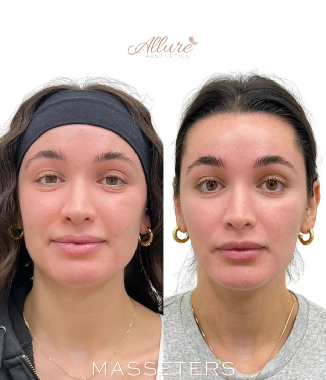 A slimmer jawline starts with understanding the cause.

If your jaw appears wider due to enlarged masseter muscles, a neuromodulator treatment may be the perfect solution. These powerful chewing muscles can become overdeveloped from genetics, clenching, or grinding, creating a broader lower face.

By strategically relaxing the masseter muscles, we can:
• Create a softer, more refined jawline
• Improve overall facial balance
• Help reduce jaw tension and teeth grinding for many patients
• Deliver subtle, natural-looking contour over time

At Allure Aesthetics, every treatment is customized to your facial anatomy and aesthetic goals because the best results never look overdone.

Ready to see if masseter neuromodulator treatments are right for you? Schedule your consultation today and let our experienced injectors create a personalized treatment plan just for you. Results may vary.