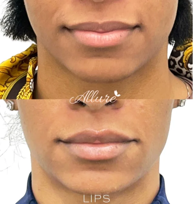 Subtle lip enhancement is about more than adding volume, it’s about creating balance. 💋 

For this patient, lip filler was used to improve structural support, refine the lip borders, and enhance overall proportion while maintaining the natural shape of her lips.👄 

When lips are treated with intention, the goal isn’t to create a dramatically different appearance. It’s to support facial harmony so the lips complement the surrounding features rather than compete with them.✨

Every lip treatment is customized based on your anatomy, existing lip structure, and long-term aesthetic goals. Sometimes the most beautiful results are the ones that simply look like you, only more balanced.💗

Ready to learn what subtle lip enhancement could look like for you? Schedule a personalized consultation with one of our providers to develop a treatment plan tailored to your facial anatomy.🙌

Results may vary.