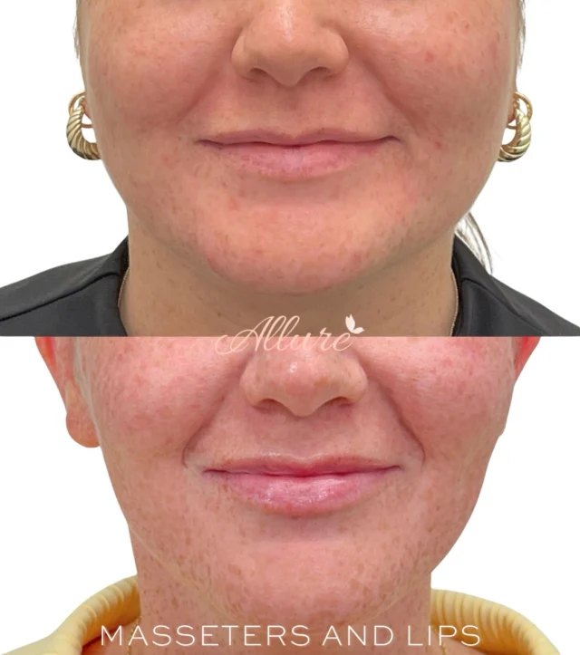 Subtle changes. Beautiful balance. ✨

For this before & after, we focused on two areas to create a softer, more balanced look:

💋 Lips: A subtle enhancement to refine her natural shape and add soft, natural-looking volume.

✨ Masseters: Treating the masseter muscles can help soften the appearance of a prominent jaw muscle over time, creating a slimmer, more V-shaped appearance through the lower face.

Small refinements can make a beautiful difference while still keeping the results natural and true to you.

Results may vary.