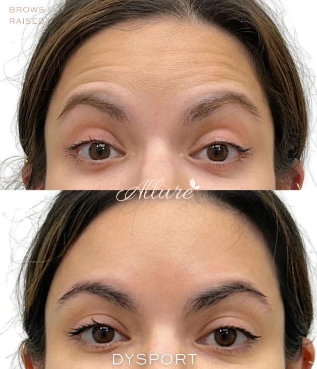 Your expressions tell a story. Over time, repeated muscle movement can leave its mark.

😊 Smiling → Crow’s feet around the eyes
🤨 Raising your brows → Horizontal forehead lines
😠 Frowning or concentrating → “11” lines between the brows

These are known as dynamic lines, created by the repetitive muscle contractions we make every day.

Dysport® works by temporarily relaxing targeted muscles to soften the appearance of these lines while maintaining natural facial movement.

The goal isn’t to change your expressions. It’s a personalized approach designed to soften the lines those expressions can leave behind.

Schedule a personalized consultation to determine the areas that may benefit from treatment.

Results may vary.
