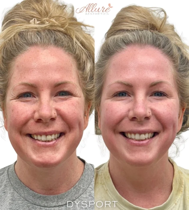Facial expressions are part of what makes us us , but over time, repeated movement can leave behind dynamic lines even when the face is at rest. ✨

For this beautiful patient, Dysport was strategically placed to soften the lines created with everyday expression while maintaining natural facial movement.

We focused on:

✨ Forehead - softening the lines created when raising the brows
✨ Crow’s feet - addressing lines around the eyes that appear with smiling
✨ Bunny lines - softening the lines along the nose created when scrunching
✨ DAOs - relaxing the downward pull at the corners of the mouth to support a more balanced lower face

The goal isn’t to change the way you express yourself. It’s thoughtful placement designed to soften dynamic lines, support facial balance, and help prevent those repetitive expressions from becoming more deeply etched over time.

Personalized placement. Intentional dosing. Results designed specifically for your facial anatomy and movement.

Results may vary.