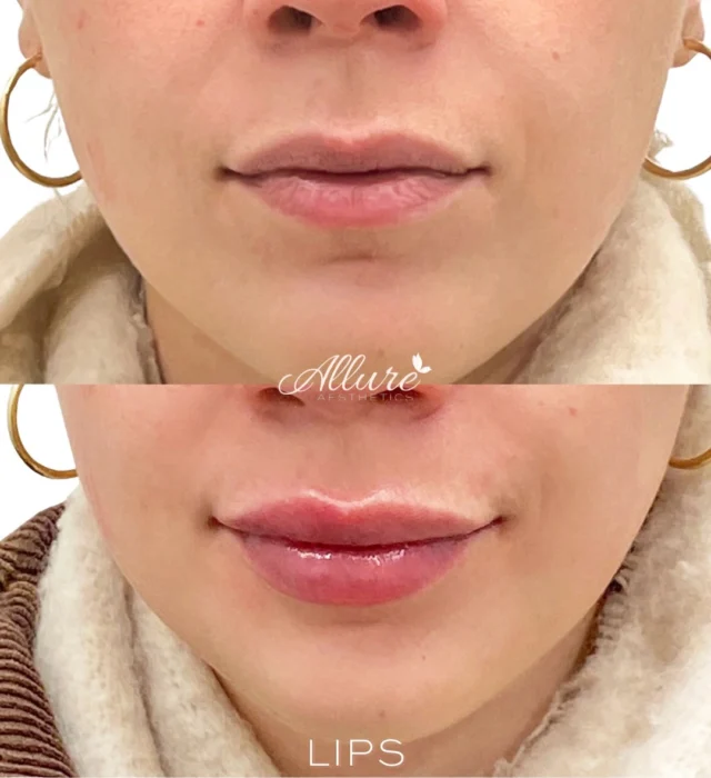 It’s all in the details. 💋

Beautiful lip enhancement isn’t just about adding volume. It’s about creating height, definition, balance, and hydration while still allowing the lips to feel beautifully proportioned to the face.

For this transformation, we focused on:

✨ Added volume
✨ Enhanced lip height
✨ More defined borders and shape
✨ A smoother, hydrated appearance
✨ Soft, balanced proportions

The result? Fuller, more defined lips with a beautifully refreshed finish.

Results may vary.