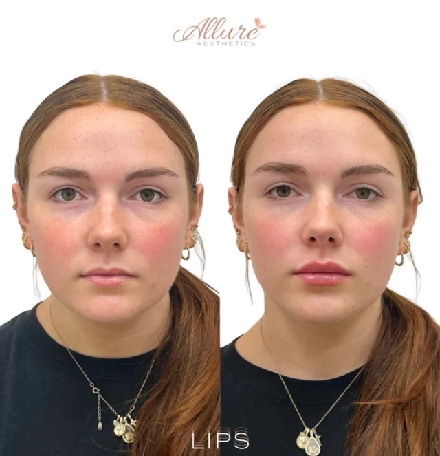 One session. Thoughtful enhancement. Refined balance. 💋

Lip filler was strategically placed to enhance structural support, improve definition, and create more balanced proportions while respecting the patient’s natural lip anatomy.

These results were achieved after one treatment session, with every placement customized to the patient’s individual features and aesthetic goals.

Results may vary.