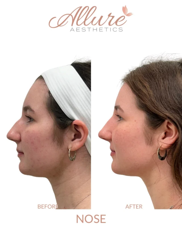 Most of the change here is in the profile. This liquid rhinoplasty used filler along the bridge to soften the line and give it a straighter shape, with two small placements of neuromodulator doing the rest, one between the brows to support the frame and one near the tip to lift it slightly. The aim was to refine the nose she has, not build a different one.

Results may vary.

#medicalaesthetics #nosefiller #liquidrhinoplasty #kingofprussia #allureaesthetics