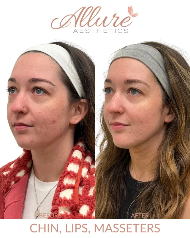 Subtle changes across the lower face, working together for a more balanced profile.

Here we refined three areas. Filler at the chin, with a neuromodulator to smooth and improve projection. Filler and a lip flip to add gentle shape to the lips. And a neuromodulator in the masseters to slim and soften the jawline over time. The goal was never a different face. Just a more harmonized one💕

Results may vary.

#medicalaesthetics #dermalfiller #lipfiller #kingofprussia #allureaesthetics