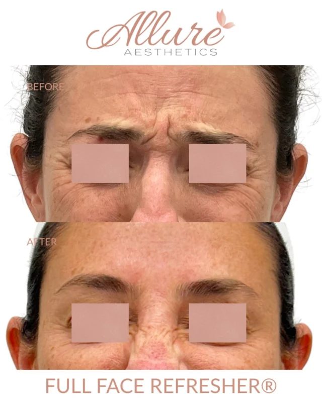 A Full Face Refresher® plus three Moxi laser sessions. Full-face neuromodulator for the forehead and smile lines, dermal filler placed for support including the nose, and laser to even out tone and texture. Planned across the whole face, not one area at a time.

Results may vary.

#medicalaesthetics #fullfacerefresher #moxilaser #kingofprussia #allureaesthetics