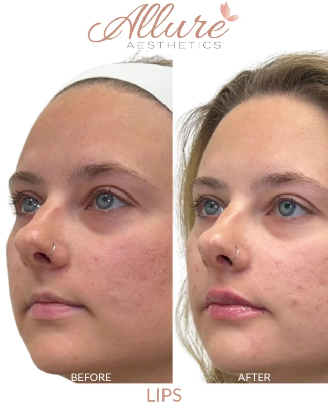 One syringe of filler was all it took to bring these lips into better proportion with the rest of her face. The goal was definition and a little more fullness, not a dramatic change, so the result still looks like her, just softer and fuller.

Results may vary.

#medicalaesthetics #lipfiller #dermalfiller #kingofprussiapa #allureaesthetics