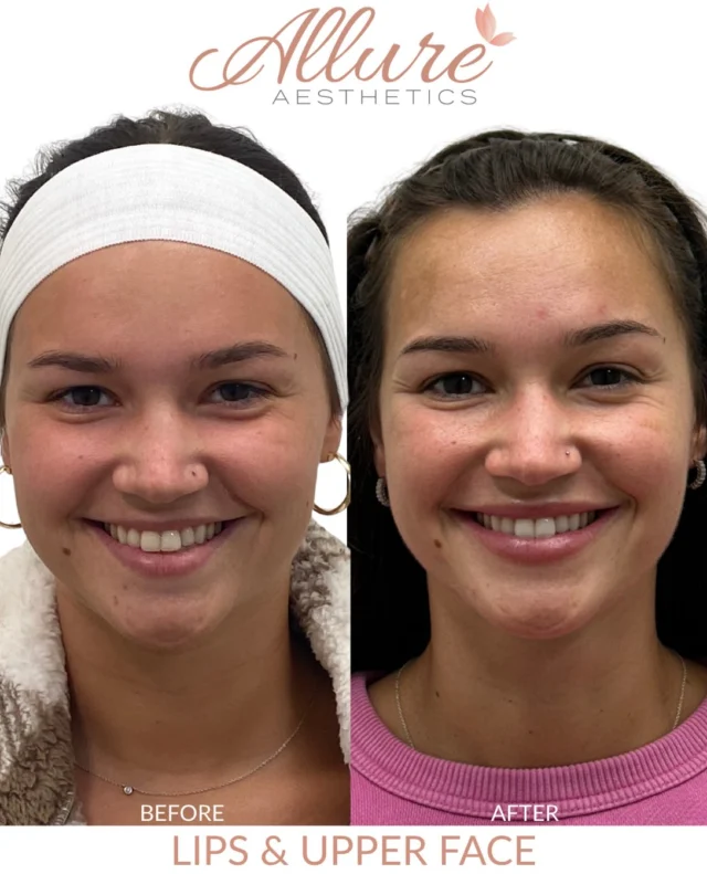 Filler gave the lips more shape and fullness, while neuromodulator relaxed the lines around the eyes, softened the movement in the forehead, and eased the dimpling in the chin. Because it was planned across several areas rather than one, her expression still moves naturally, just with less tension holding it.

Results may vary.

#medicalaesthetics #lipfiller #dermalfiller #kingofprussiapa #allureaesthetics