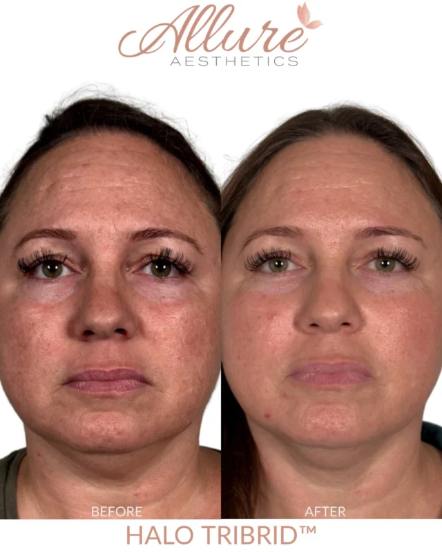 Correction in progress, six weeks after HALO TRIBRID™ ✨

This client’s goals were to improve texture, address visible sun damage, even out her tone and invest in overall skin quality with preventative aging in mind, so we built her treatment around those goals.

We prioritized deeper collagen remodeling first, then used TRIBRID’s additional wavelengths for pigment correction and surface refinement. That’s what makes this technology so customizable. We can shift the focus depending on what we’re actually trying to accomplish for the skin in front of us.

At six weeks, we’re already seeing smoother texture, softening in the appearance of scarring, more even pigmentation and an overall more refined quality to the skin. Swipe through, because some of the best changes are in the close-ups.

And she isn’t at her final result yet. The deeper collagen remodeling continues for months after treatment, so we expect her texture and overall skin quality to keep evolving from here. Her plan also includes a customized ZO Skin Health regimen to support her skin between treatments, and next we’ll shift more attention toward tone and pigmentation by incorporating BBL.

Intentional skin correction is about more than the treatment itself. It’s about knowing what to prioritize and how to build on the result.

Results may vary.

#halotribrid #medicalaesthetics #skinhealth #kingofprussia #allureaesthetics