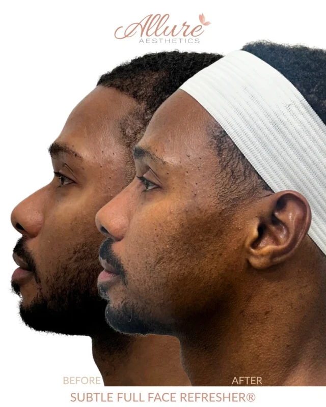 Subtle was the whole point of this Full Face Refresher®. The nose got a little extra attention with a liquid rhinoplasty to smooth and refine the profile, while filler at the chin, jawline and smile lines added definition and support. A small amount of neuromodulator kept the expression soft and natural. Each change was chosen to bring the feature already there into clearer focus.

Results may vary.

#medicalaesthetics #fullfacerefresher #mensaesthetics #kingofprussia #allureaesthetics