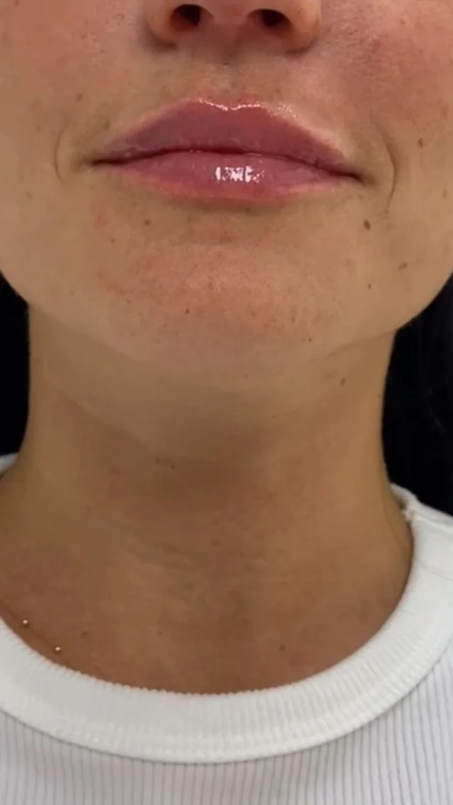 Lip filler, minutes after treatment ✨

The goal was shape before size. By carefully defining the lip border and Cupid’s bow, we restored structure and enhanced her natural shape. The result? Balanced, beautiful lips that complement her features while preserving natural movement.

Some of what you’re seeing is swelling, which typically settles over the next two to three weeks as your final results take shape. If you’ve been considering lip filler, your provider will walk you through your goals and recommend an approach that complements your natural features.

Results may vary.

#lipfiller #dermalfiller #medicalaesthetics #kingofprussia #allureaesthetics