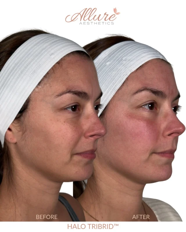 Correction in progress with HALO TRIBRID™.

This client’s goals were to even out pigmentation, refine her overall skin quality and stay ahead of aging, so we built her treatment around exactly that. We focused on visible pigment while also targeting fine lines, texture and deeper collagen support, which TRIBRID’s three wavelengths let us do in one treatment.

We’re already seeing more even-looking tone, smoother texture, and visible softening through the forehead lines, under-eyes and laugh lines. The close-ups are where the finer detail comes through.

You’ll notice some redness in the after photos, which is expected at this stage of healing. Her tone will keep settling as it fades, and with collagen remodeling still underway, we expect fine lines and texture to keep improving over the coming months. A customized ZO Skin Health regimen is supporting her results between treatments.

Intentional skin correction is about more than one treatment. It’s about building a plan around what each client wants for their skin. 

Interested in getting started on your skin journey? Comment your biggest skin concern below and we’ll send you a DM with where we’d start 👇

Results may vary.

#halotribrid #medicalaesthetics #skinhealth #kingofprussia #allureaesthetics