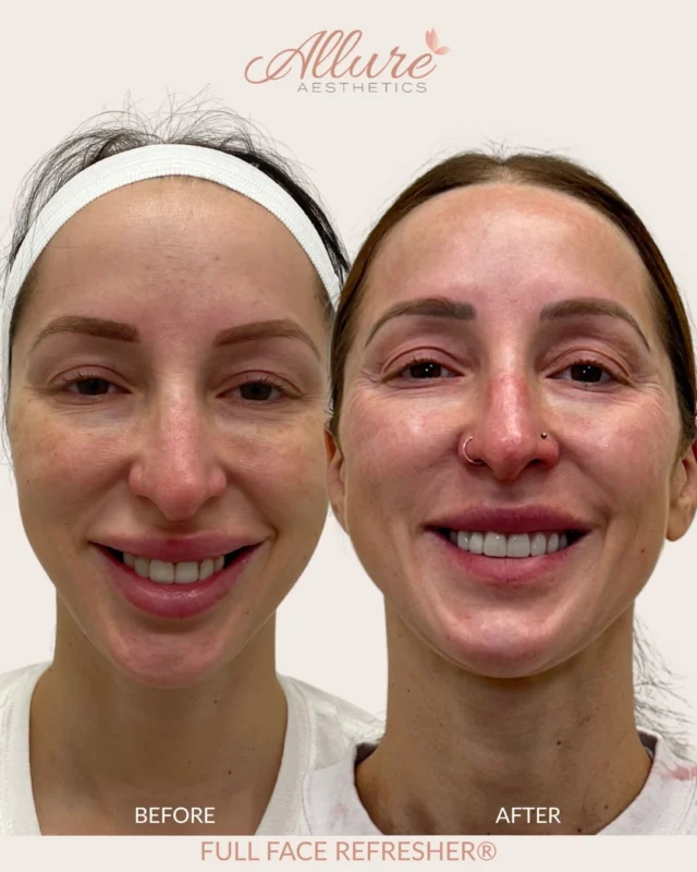 Eight years, one face, one plan.

This Full Face Refresher® is special because it shows the progression of our patient over 8 years. Over the course of her treatment, we dissolved and refilled her lips, added neuromodulators, restored her cheeks and softened her smile lines, refined her nose (without surgery), and brought definition to her chin, jawline and temples.

Every single step was planned around balancing her whole face. That’s what makes the Full Face Refresher® so good.

Results may vary.

#medicalaesthetics #beforeandafter #fullfacerefresher #mainlinepa #allureaesthetics